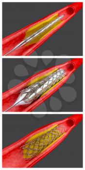 Stenting Clipart