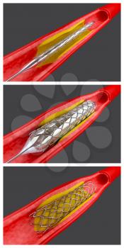 Vasculature Clipart