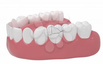 Crack tooth, tooth disease, 3d rendering. Computer digital drawing.