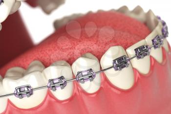 Teeth with braces or brackets in open human mouth. Dental care concept. 3d illustration