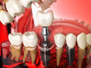 Tooth implant in the model human teeth, gums and denturas. Dental medicine stomatology concept. 3d illustration