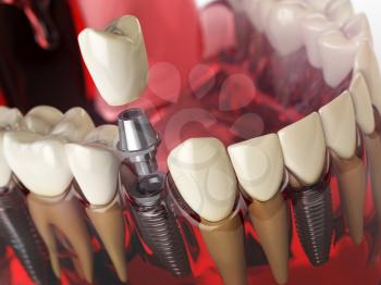 Tooth implant in the model human teeth, gums and denturas. Dental medicine stomatology concept. 3d illustration