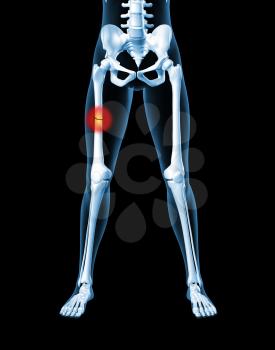 3D render of a medical female skeleton with a broken leg bone highlighted