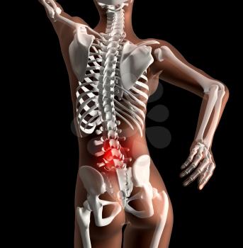 3D render of a female skeleton with pain in back highlighted