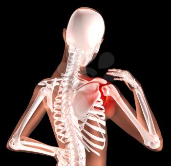 3D render of a female medical skeleton with shoulder pain highlighted