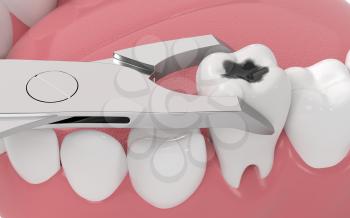 Tooth decay, unhealthy teeth, 3d rendering. Computer digital drawing.