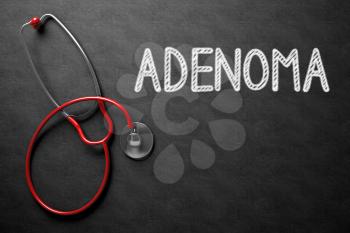 Medical Concept: Adenoma - Medical Concept on Black Chalkboard. Medical Concept: Adenoma -  Black Chalkboard with Hand Drawn Text and Red Stethoscope. Top View. 3D Rendering.