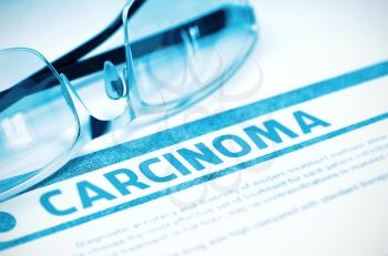 Carcinoma - Printed Diagnosis on Blue Background and Spectacles Lying on It. Medicine Concept. Blurred Image. 3D Rendering.