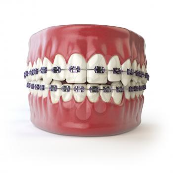 Teeth with braces or brackets isolated on white. Dental care concept. 3d illustration
