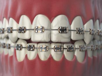 Teeth with braces or brackets in open human mouth. Dental care concept. 3d illustration