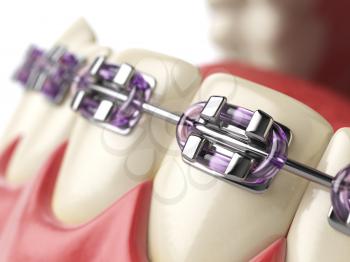 Teeth with braces or brackets in open human mouth. Dental care concept. 3d illustration
