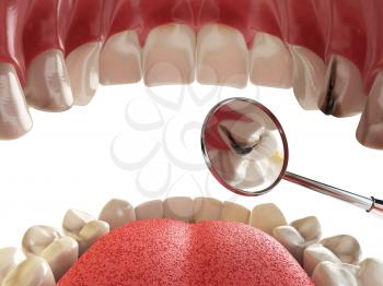 Human tooth with cariesand hole and tools. Dental searching concept. Teeth or dentures. 3d illustration