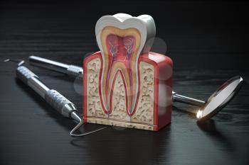 Tooth model cross section with dental tools on black wooden table. Close up. Dental treatmant and hygiene concept. 3d illustration